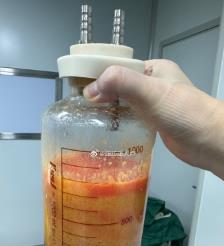 香河水动力吸脂手术要做多久？